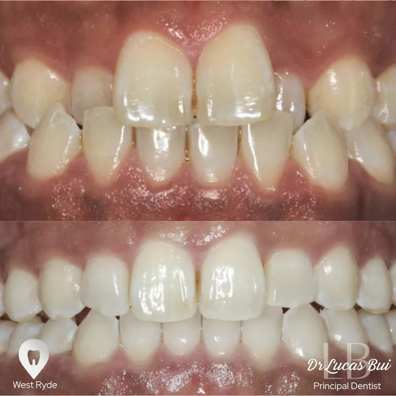 Clear Aligners transformation by Dr Lucas Bui