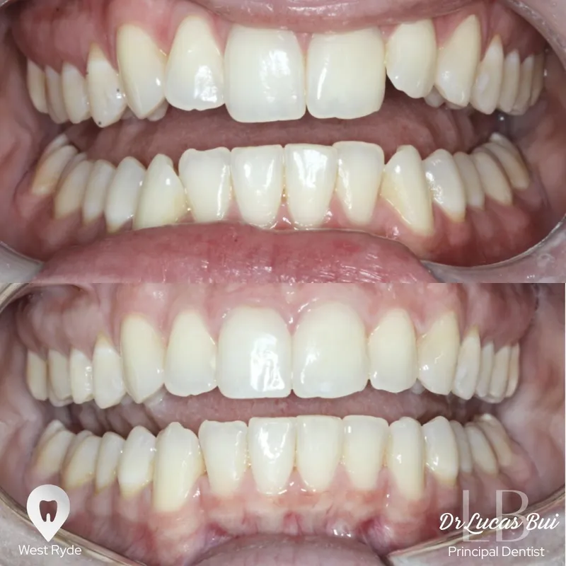 Clear Aligners transformation by Dr Lucas Bui