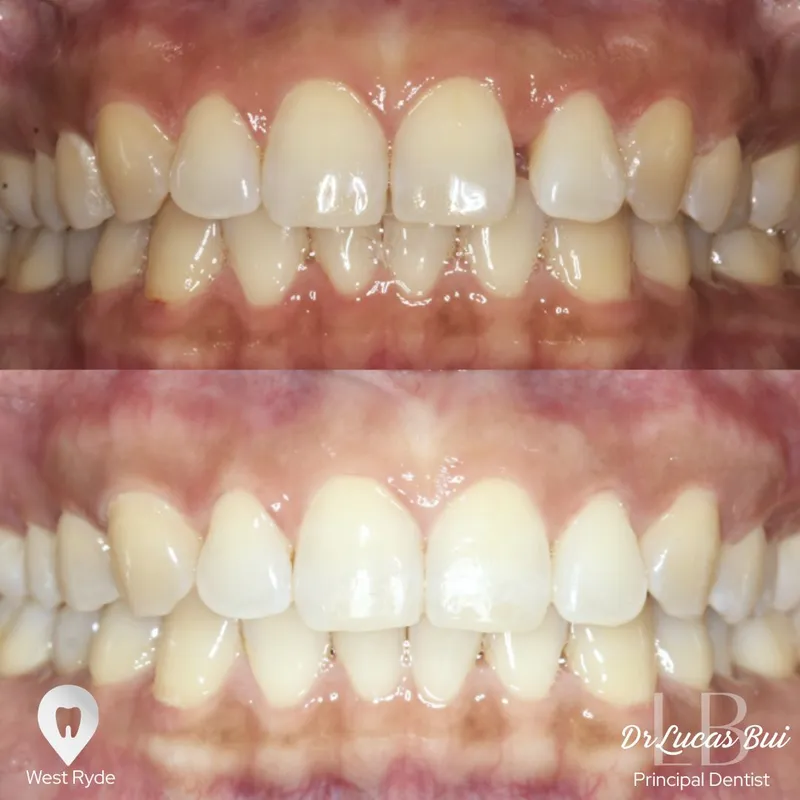 Clear Aligners transformation by Dr Lucas Bui