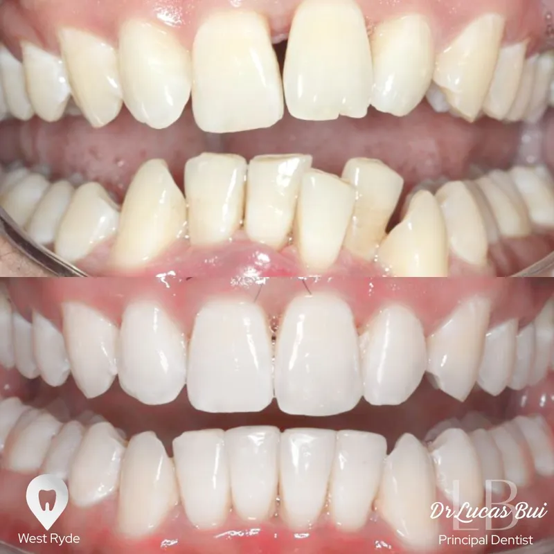 Clear Aligners transformation by Dr Lucas Bui