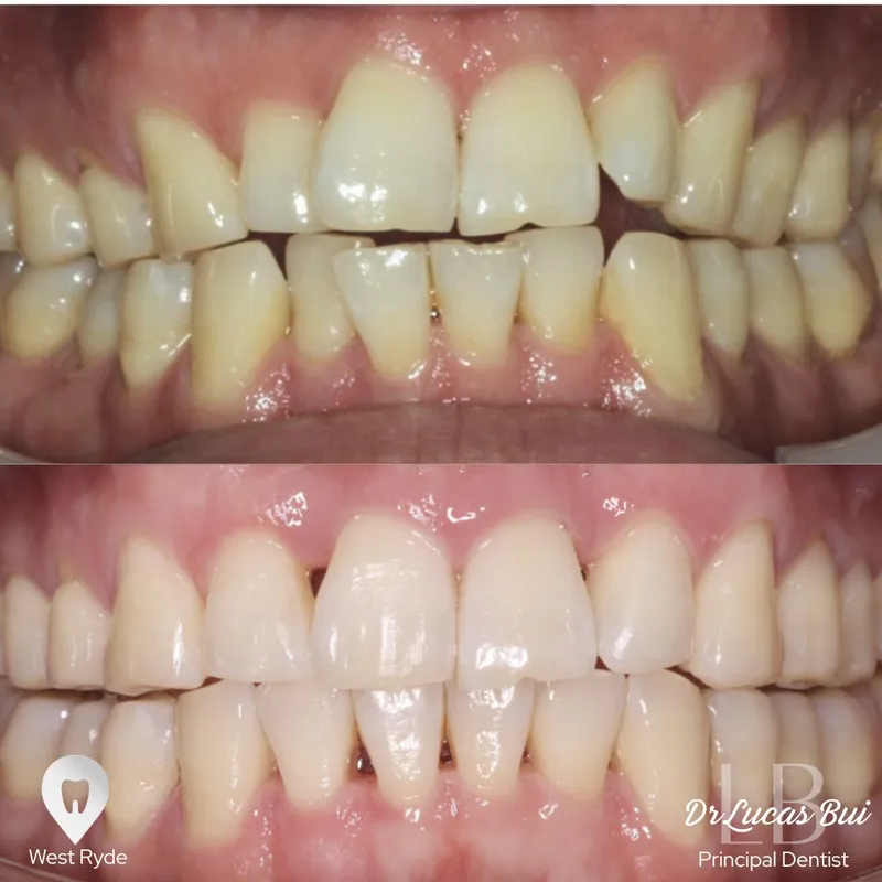 Clear Aligners transformation by Dr Lucas Bui