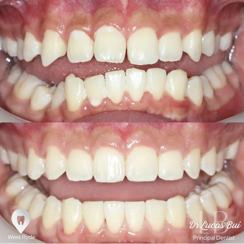 Clear Aligners transformation by Dr Lucas Bui