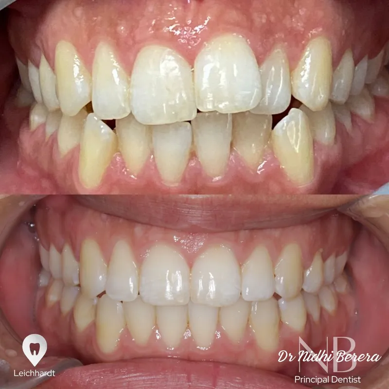 Clear Aligners transformation by Dr Nidhi Berera