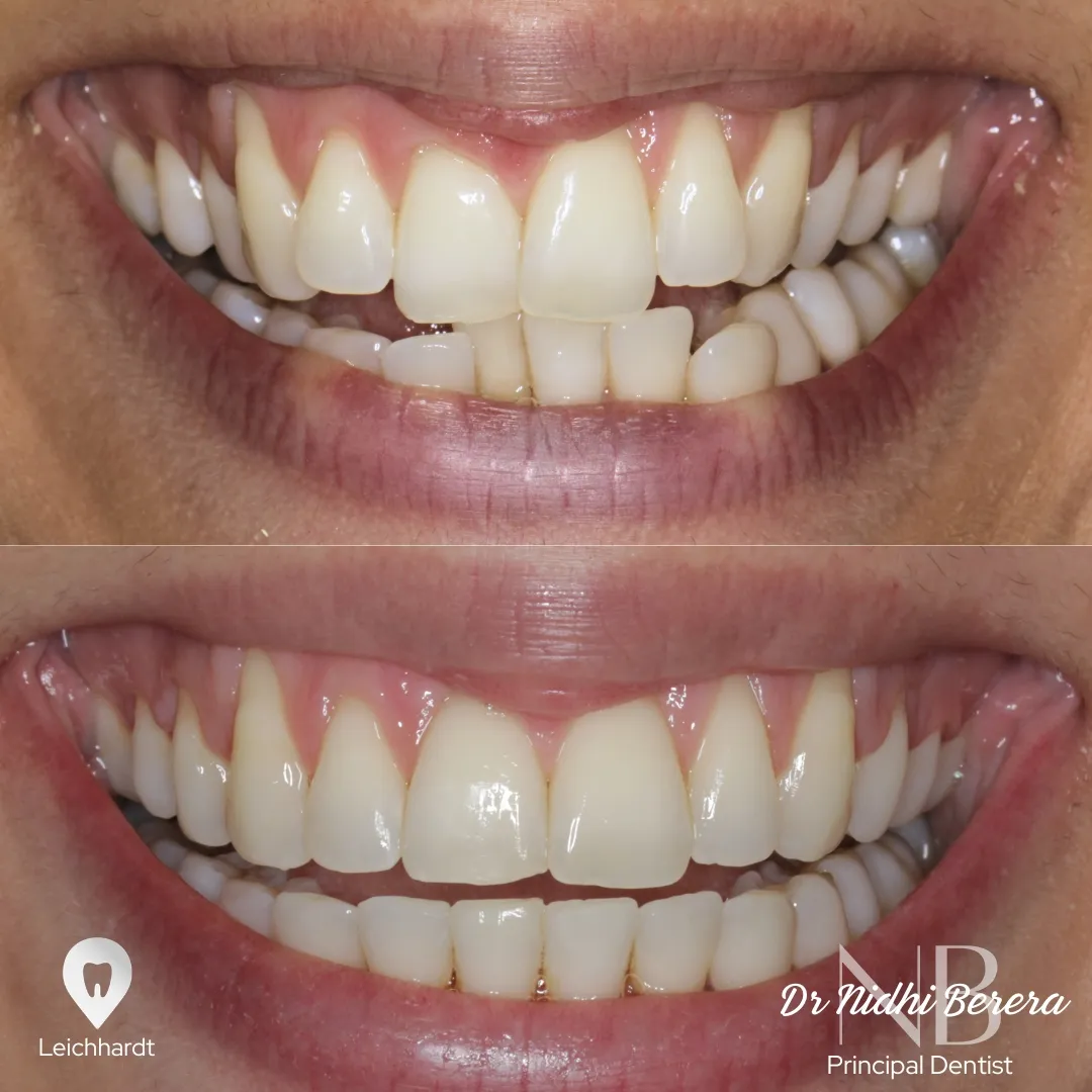 Invisalign before and after smile transformation, Leichhardt patient