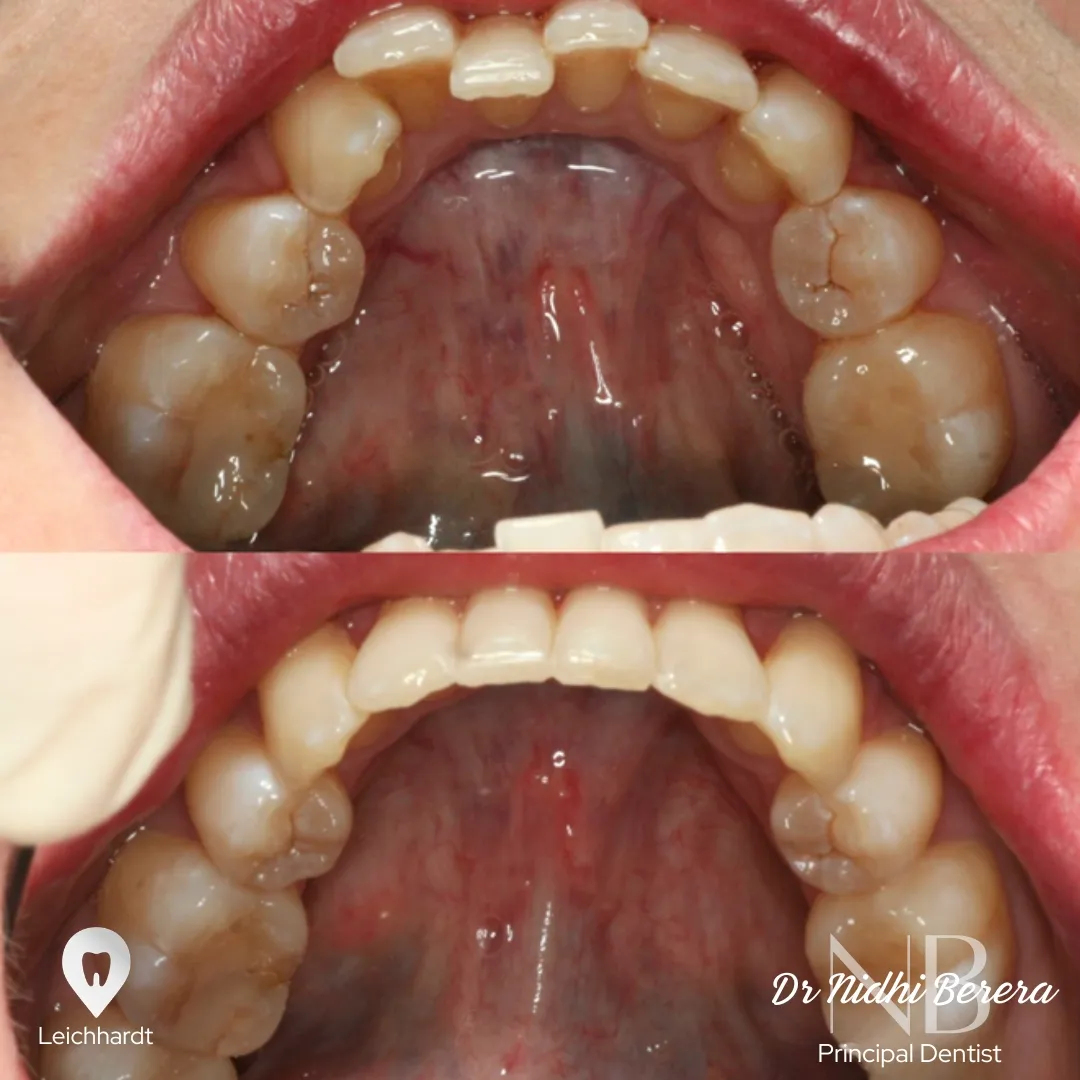 Invisalign before and after, Leichhardt patient with corrected gap