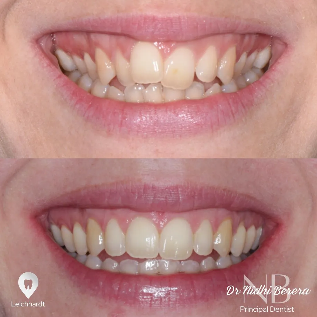 Clear aligner before and after, lower arch realignment