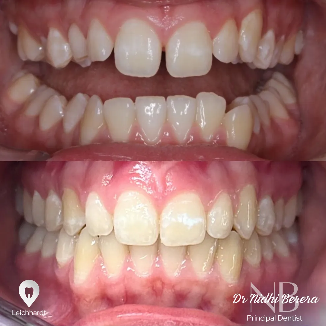 Invisalign before and after, alignment correction by Dr Nidhi Berera Leichhardt