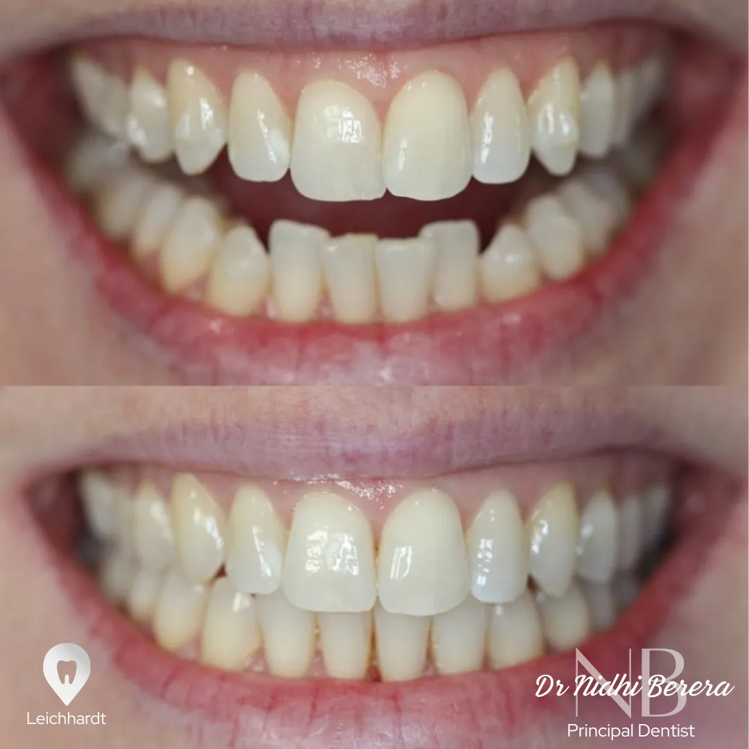 Invisalign before and after, smile transformation Leichhardt