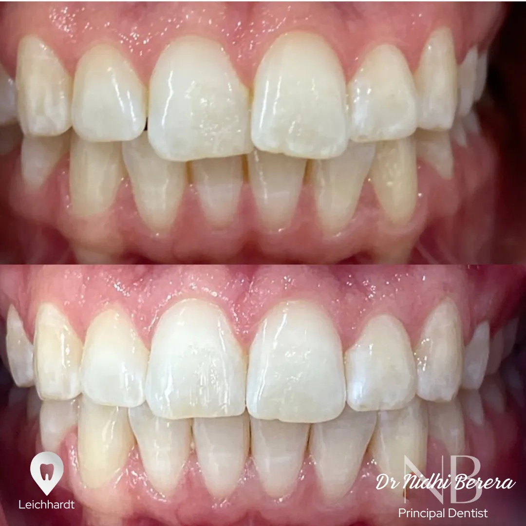 Invisalign before and after, full arch realignment Leichhardt