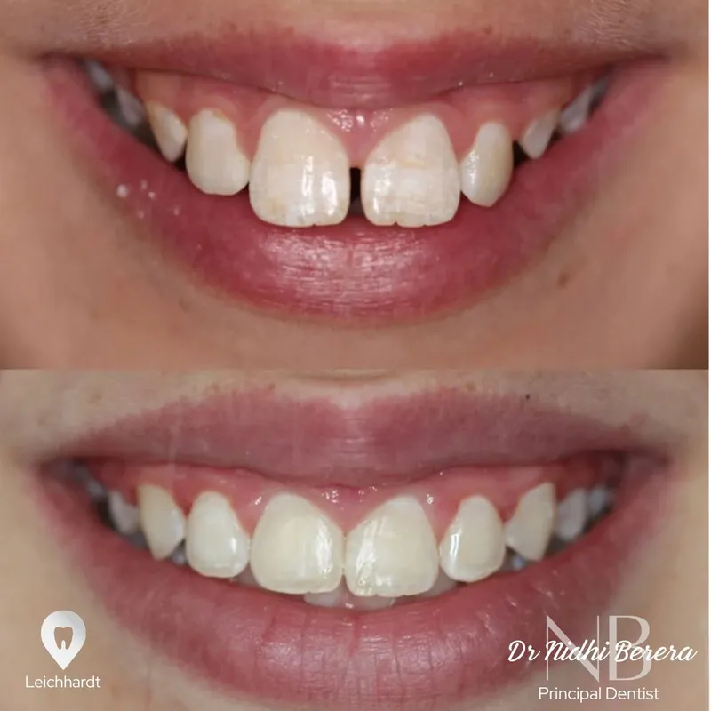 Orthodontics transformation by Dr Nidhi Berera