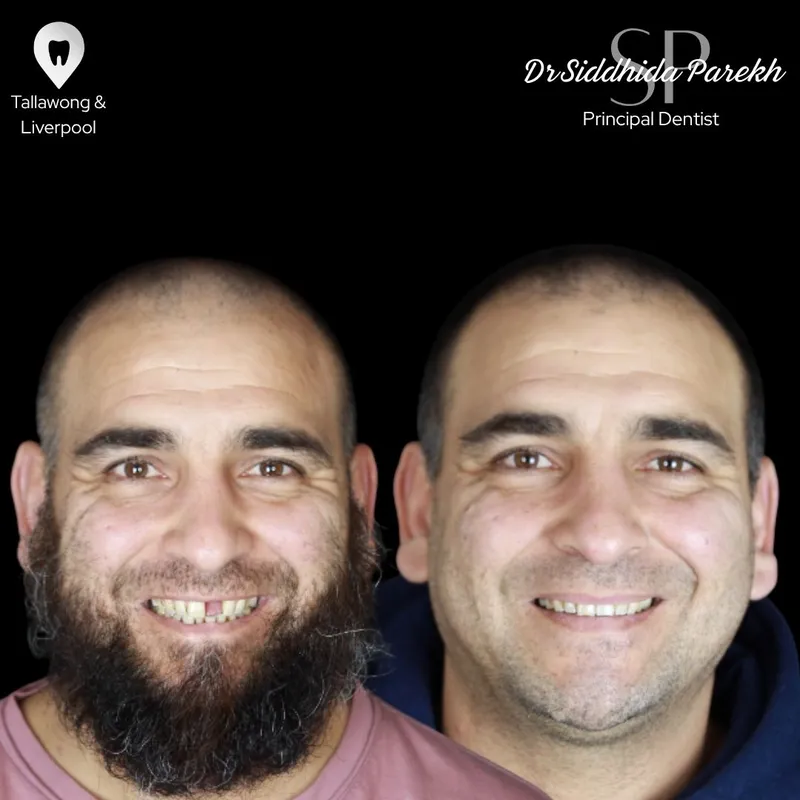 Implants transformation by Dr Siddhida Parekh