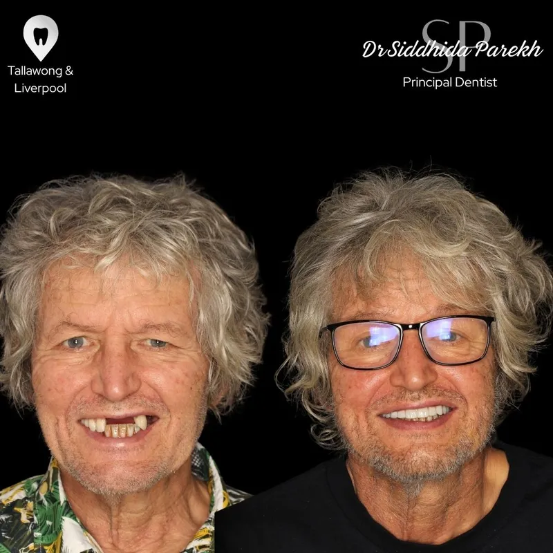 Implants transformation by Dr Siddhida Parekh