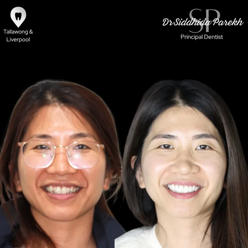 Veneers transformation complete!