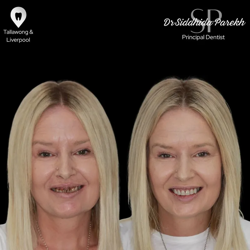 Veneers transformation complete!