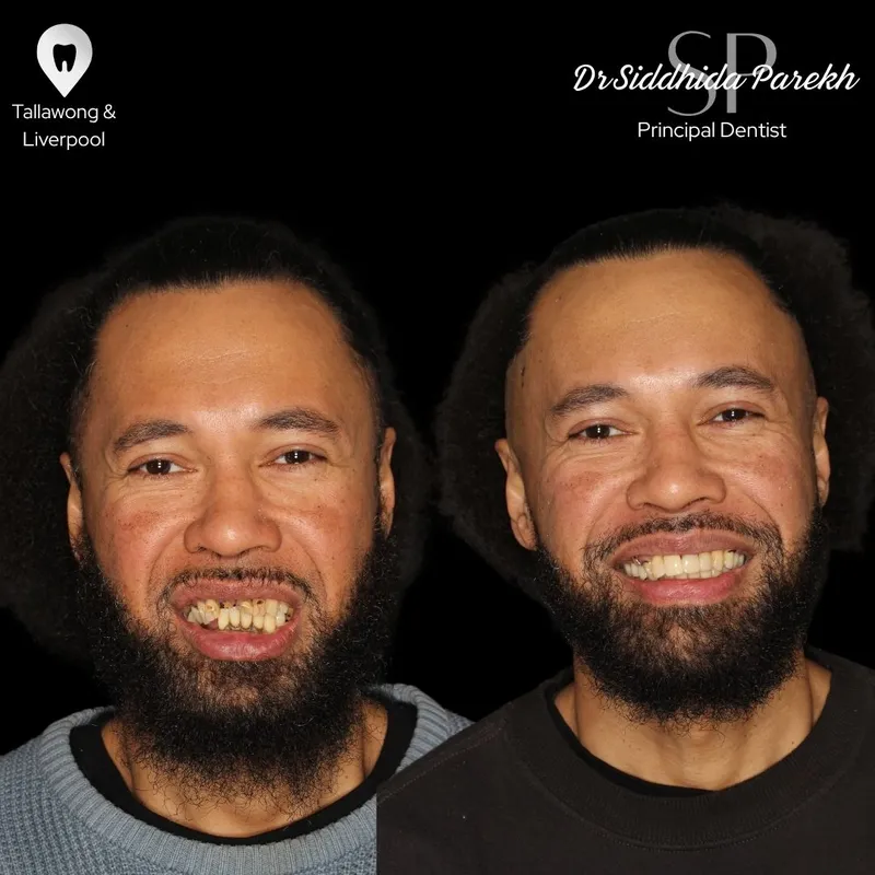 Veneers transformation complete!