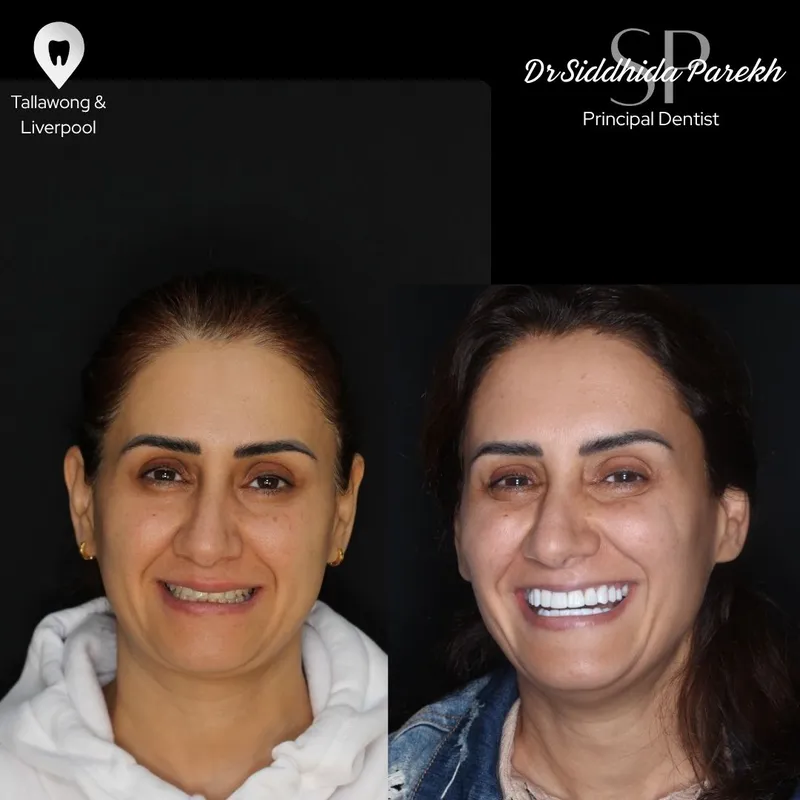 Veneers transformation complete!