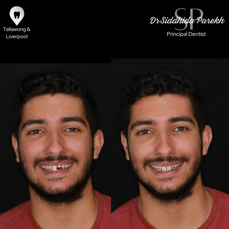 Veneers transformation complete!