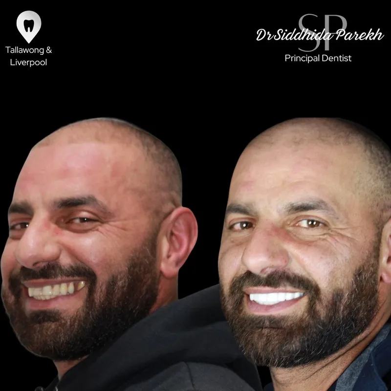 Veneers transformation complete!