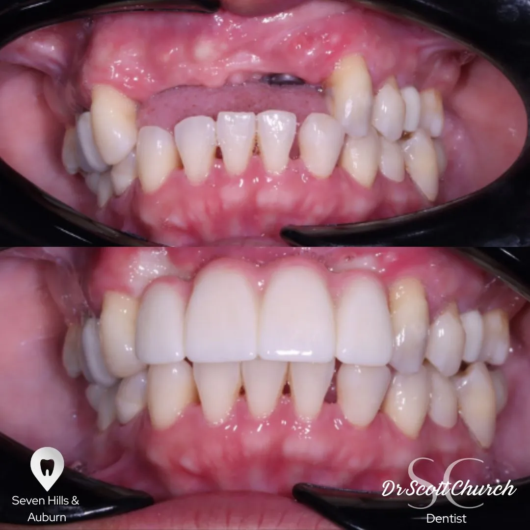 Implant case showing precision placement and restoration, Northbridge