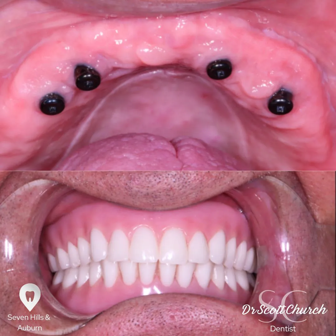 Anterior implant case, aesthetic restoration, Northbridge