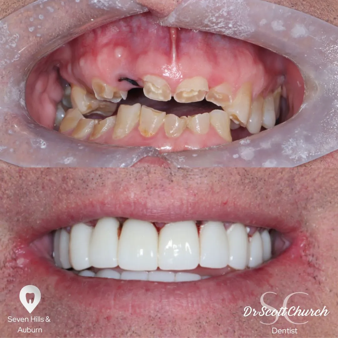 Implant restoration case, single tooth replacement, Northbridge