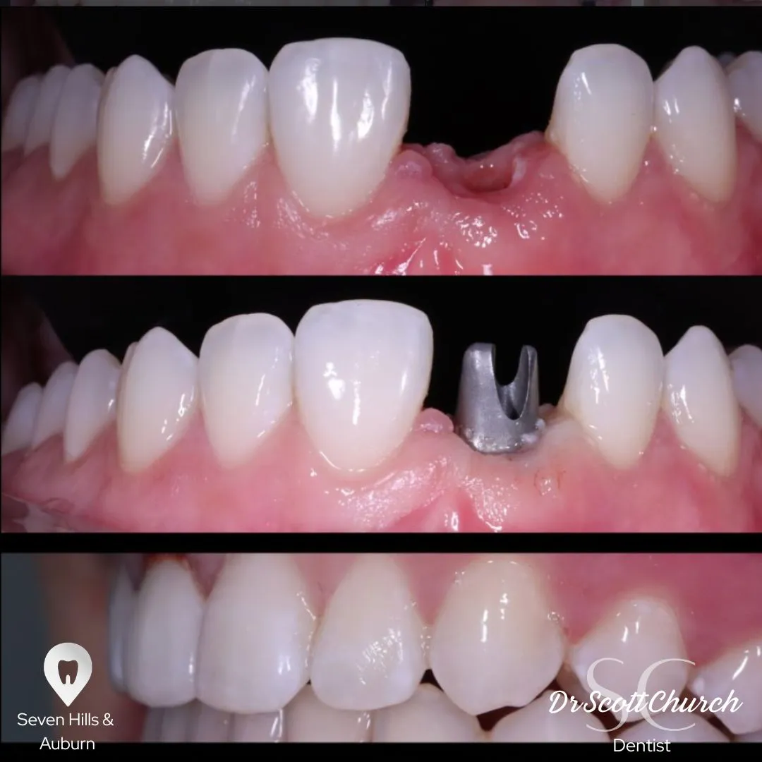 Full-arch implant case completed by Dr Scott Church