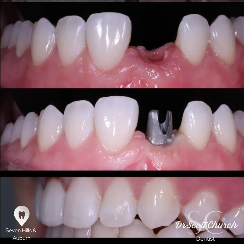Implants transformation by Dr Alice Im