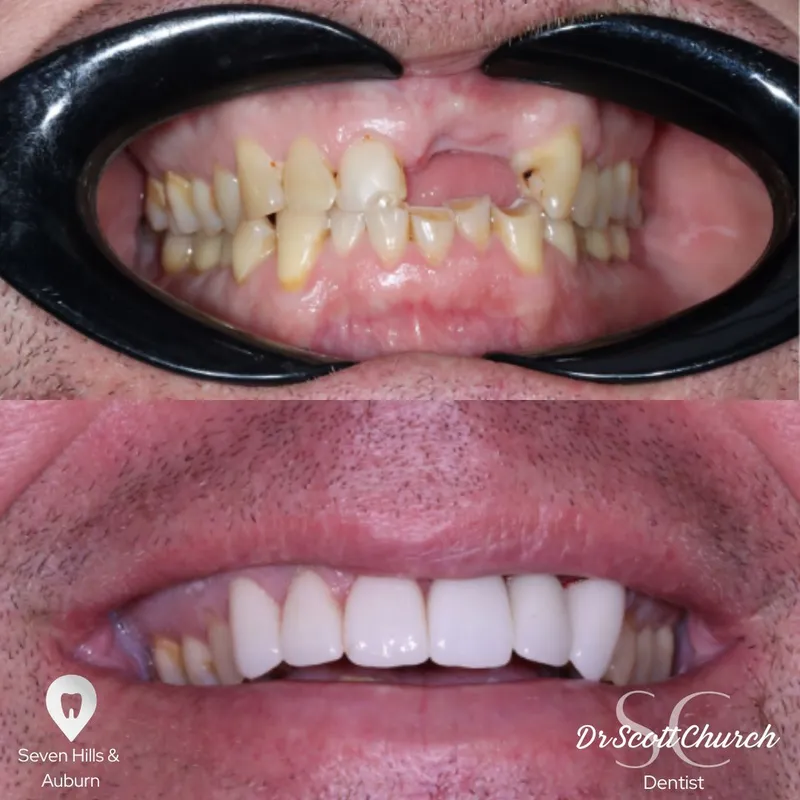 Veneers transformation by Dr Scott Church