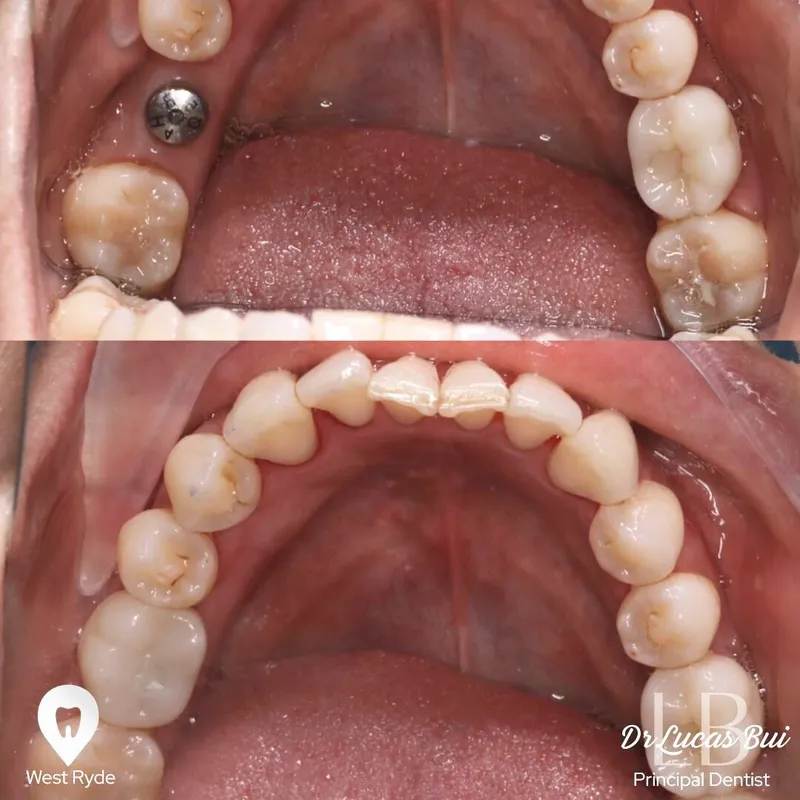 Implants transformation by Dr Lucas Bui