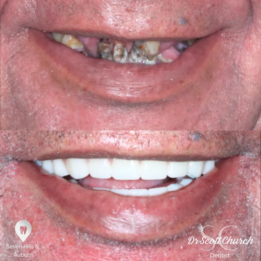 Dental implant case at My Local Dentists Northbridge by Dr Scott Church