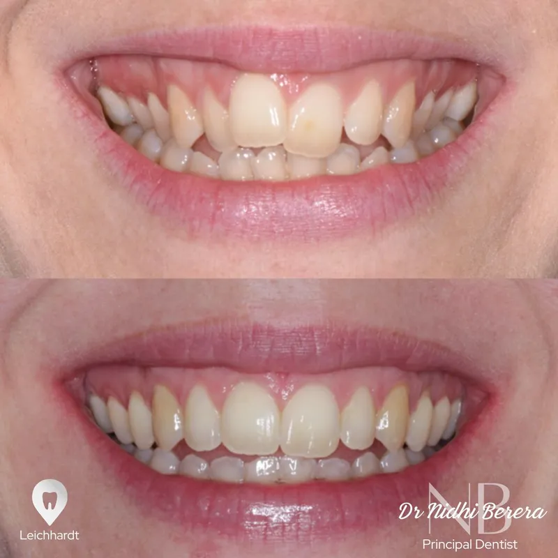 Clear Aligners transformation by Dr Nidhi Berera