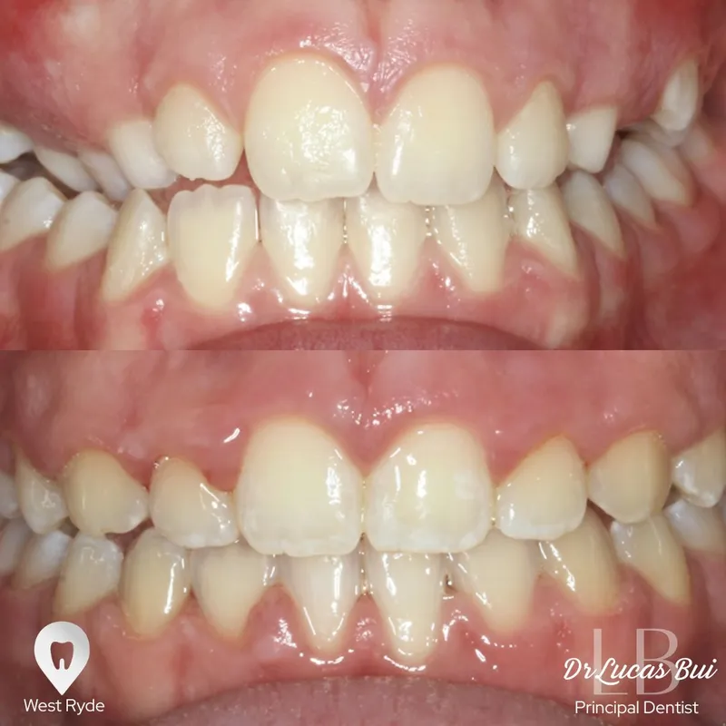 Orthodontics transformation by Dr Lucas Bui
