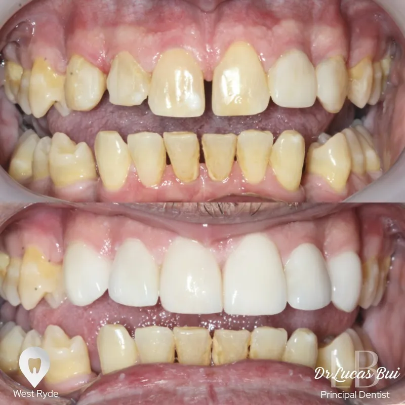Veneers transformation complete!