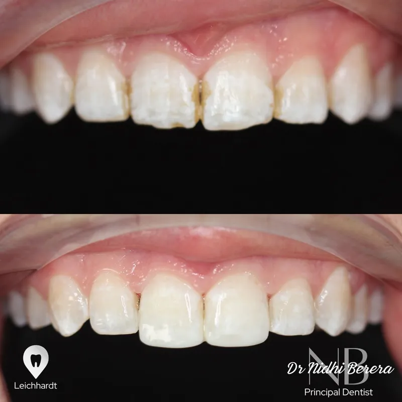 Veneers transformation by Dr Nidhi Berera