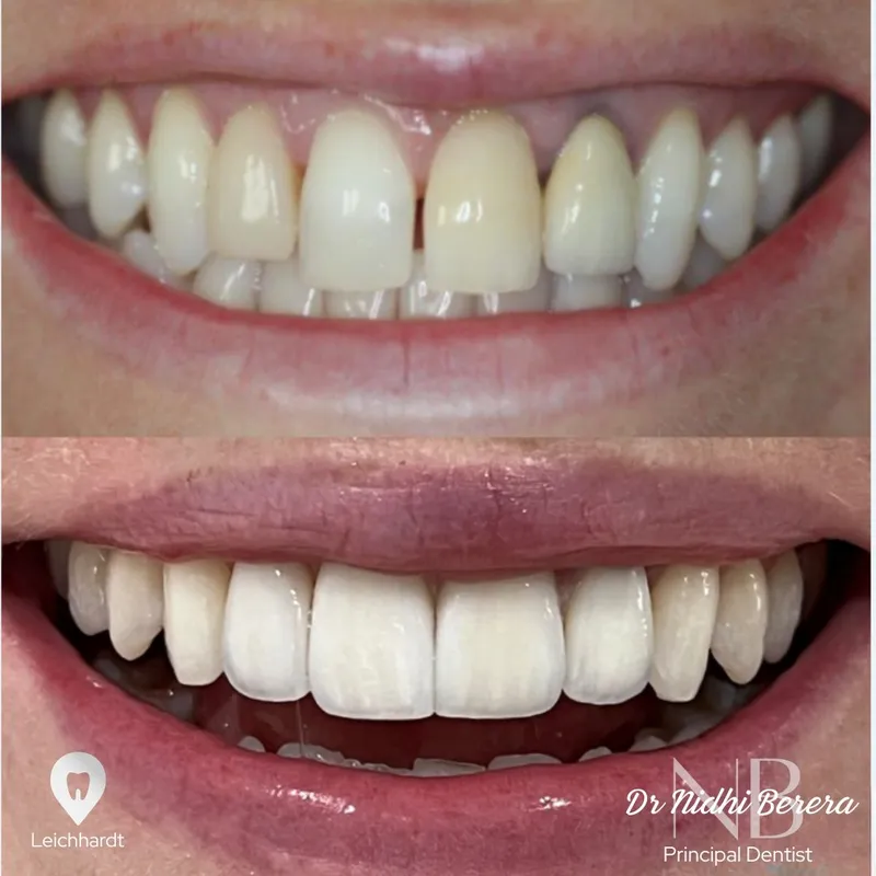 Veneers transformation complete!