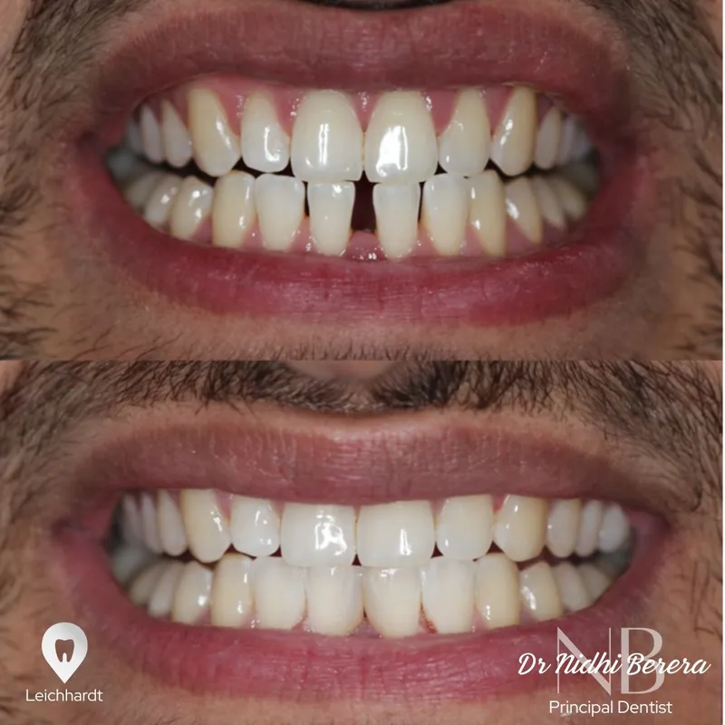 Veneers transformation by Dr Nidhi Berera