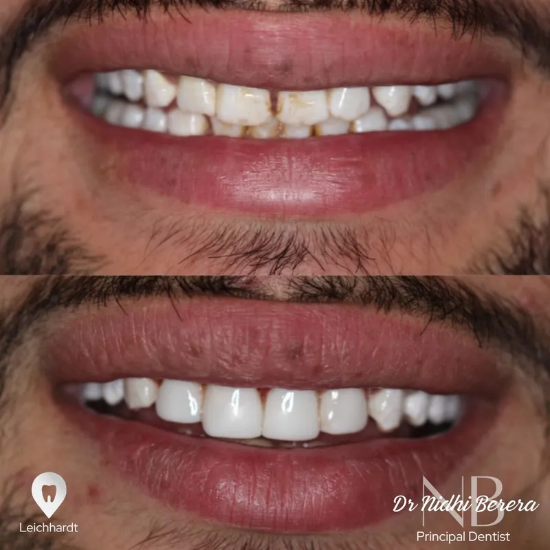 Veneers transformation by Dr Nidhi Berera
