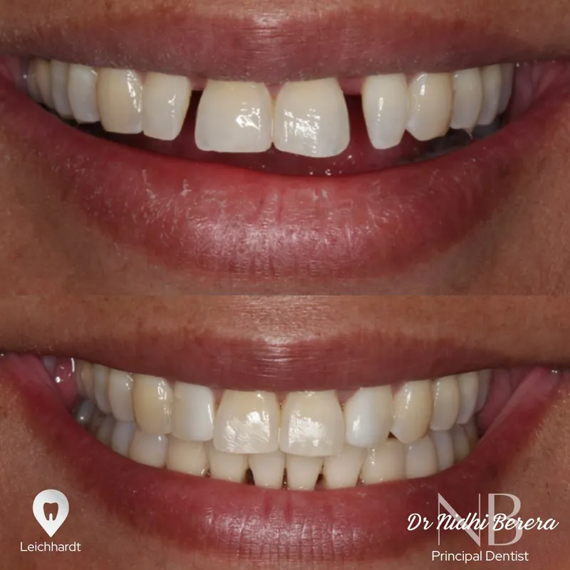 Veneers transformation by Dr Nidhi Berera