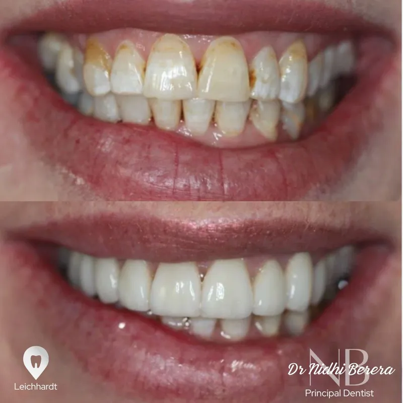 Veneers transformation by Dr Nidhi Berera