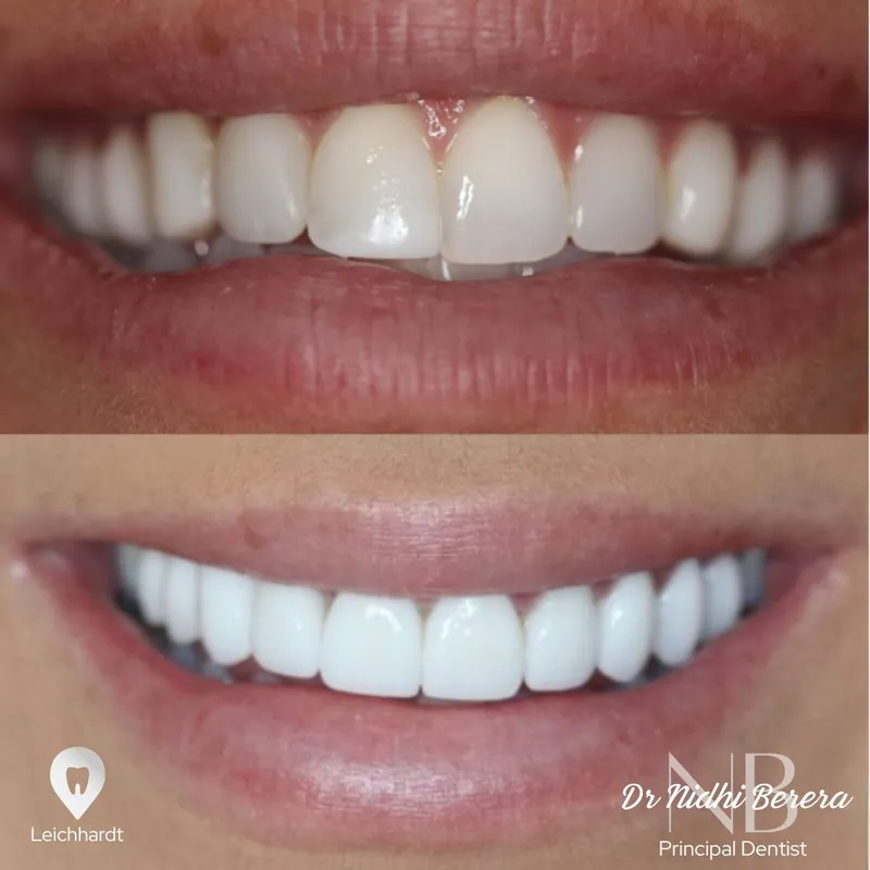 Veneers transformation by Dr Nidhi Berera