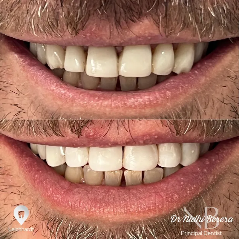 Veneers transformation by Dr Nidhi Berera
