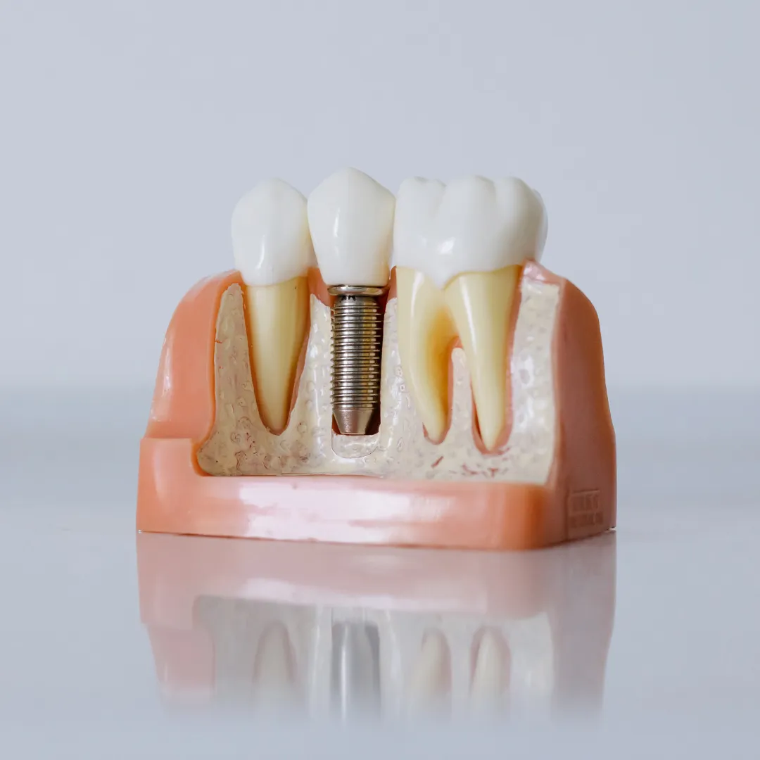 Cross-section model of a dental implant showing titanium post integrated with the jawbone