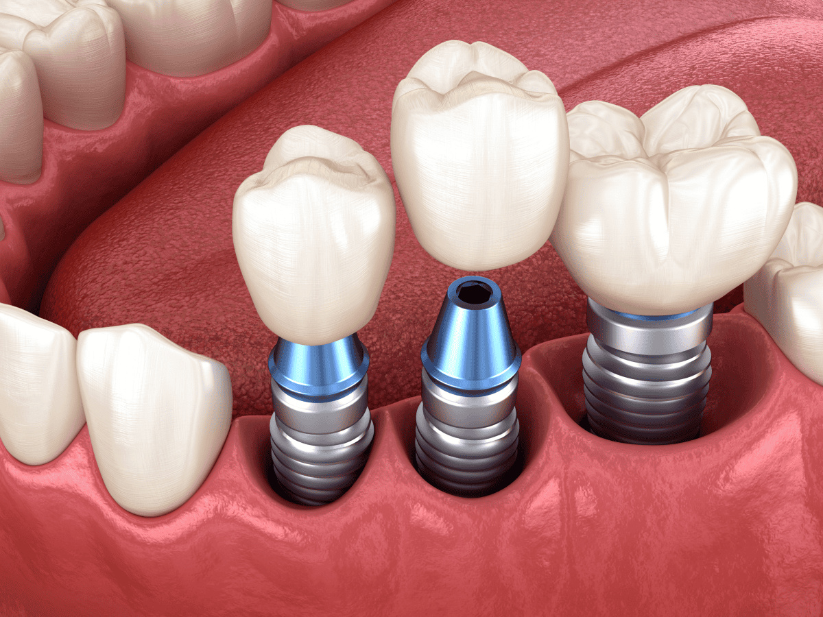 Dental Implants Cost per Tooth: Factors Affecting Prices & Savings Tips