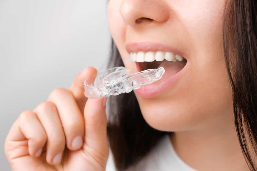 Do Invisible Braces Work? Benefits and Results Explained
