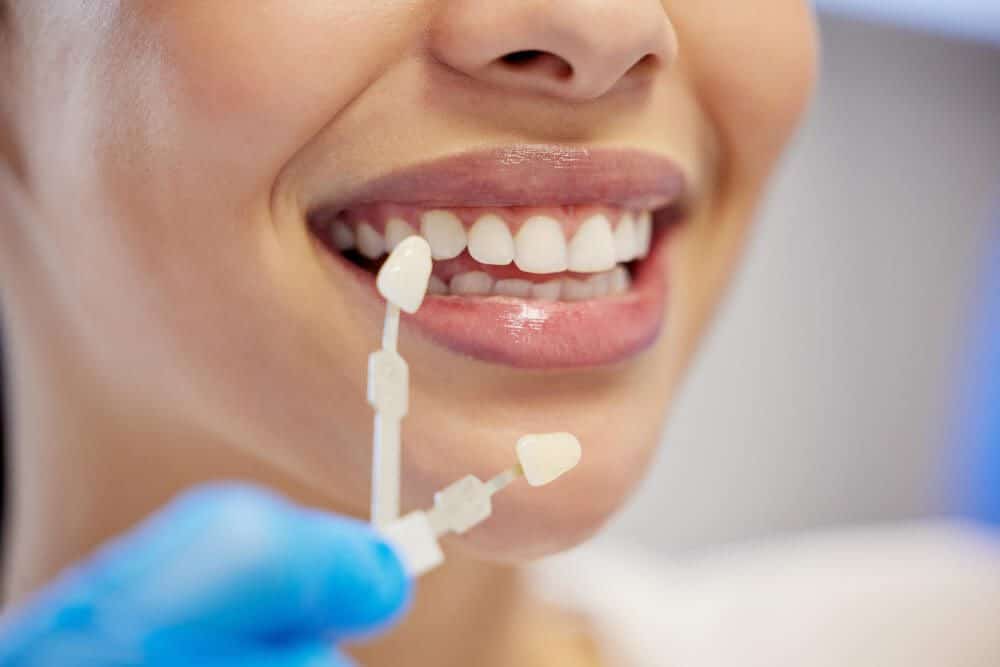 Shaved Teeth for Veneers: Do They Need to Be Filed Down?