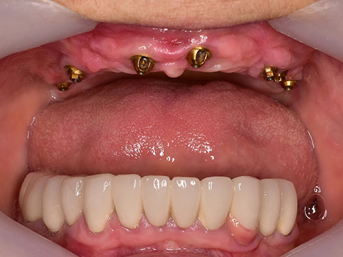 dental Implant after 1