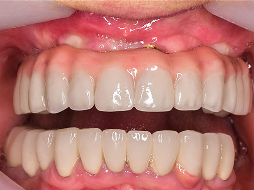 dental Implant before 1