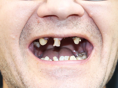 dental Implant before 2