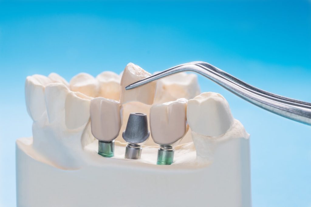 who should not have dental implants