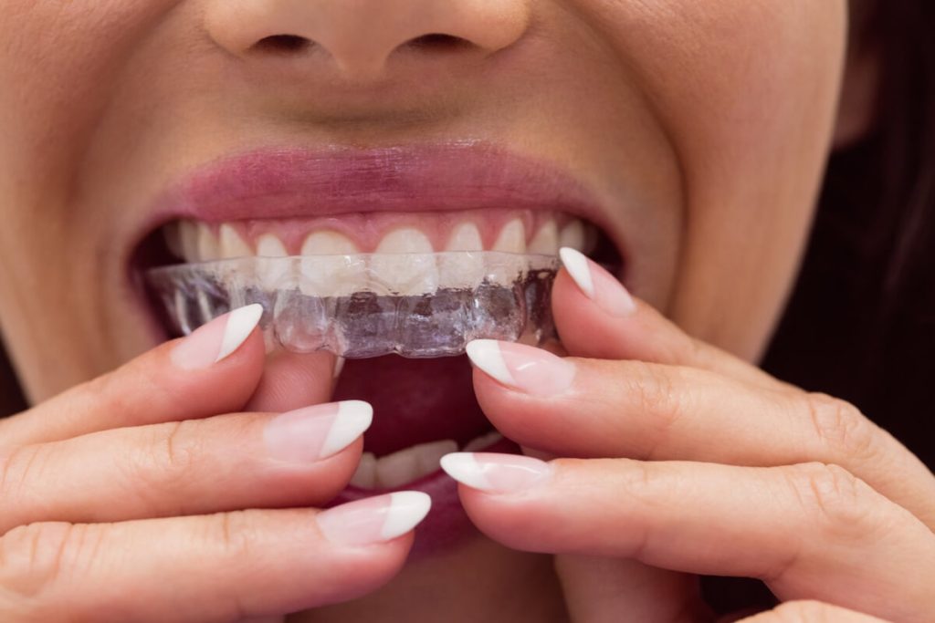 how to straighten your teeth braces and invisalign explained